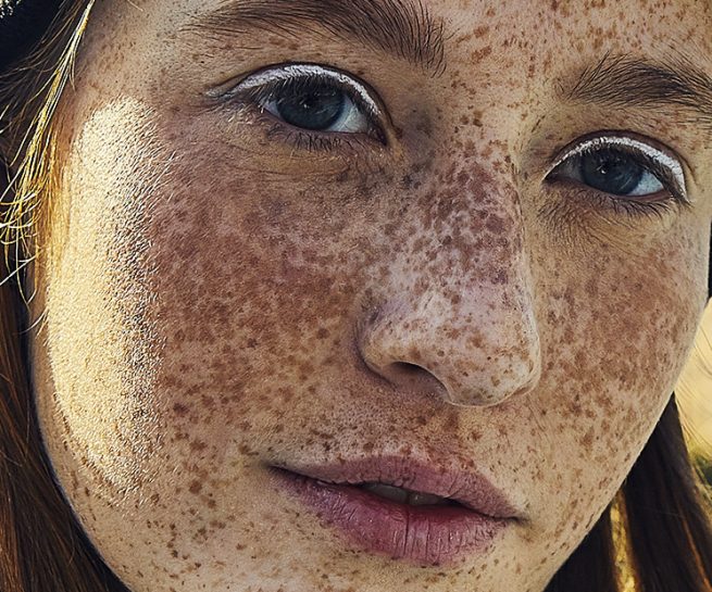 Gesicht mit Sommersprossen